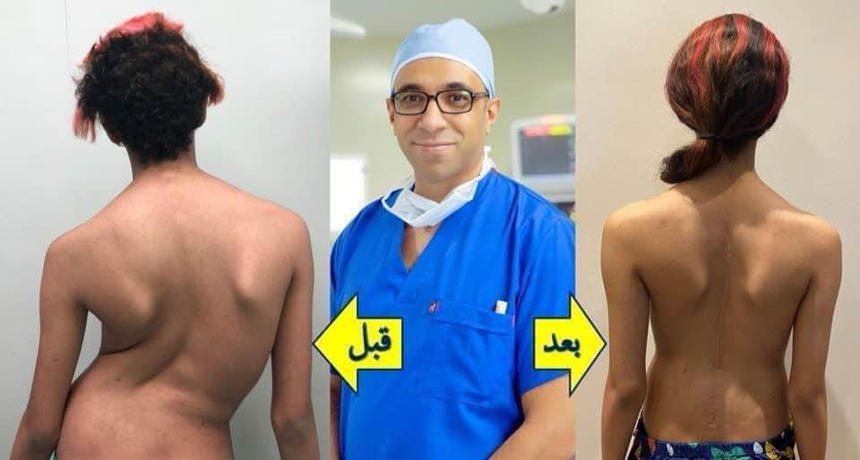 Scoliosis Correction Surgeries
