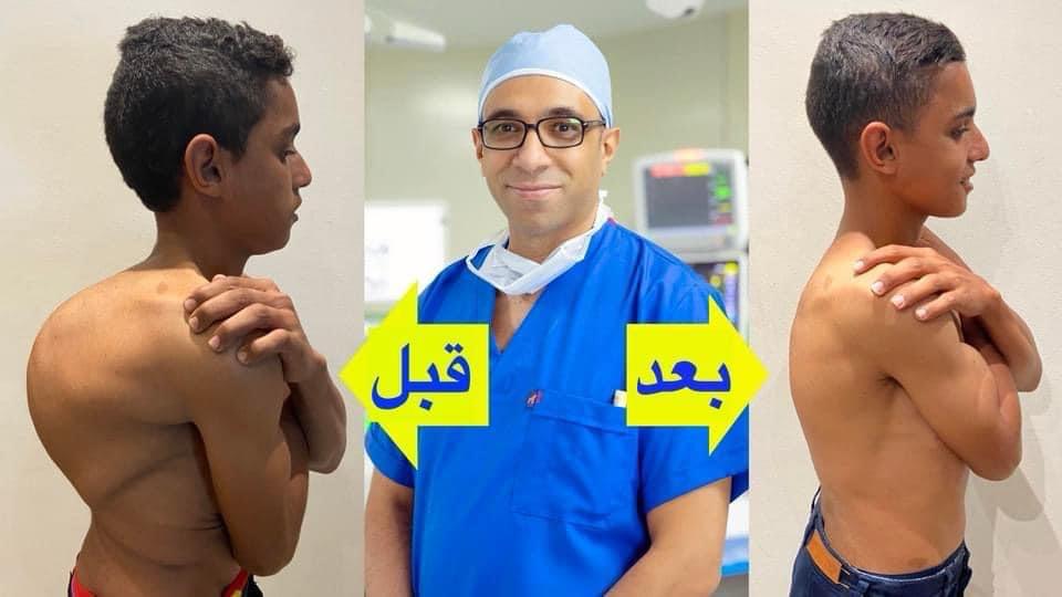 الاعوجاج المصاحب للتحدب بالعمود الفقري