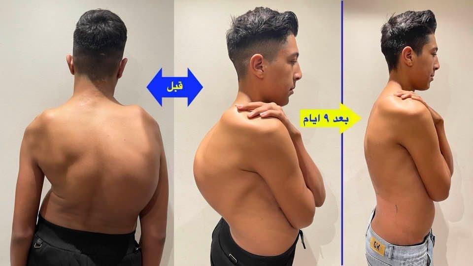 الاعوجاج المصاحب للتحدب بالعمود الفقري