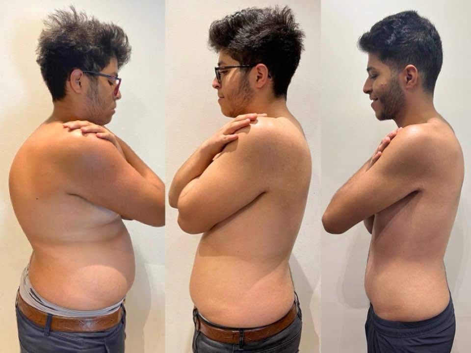 Kyphosis Correction Surgeries