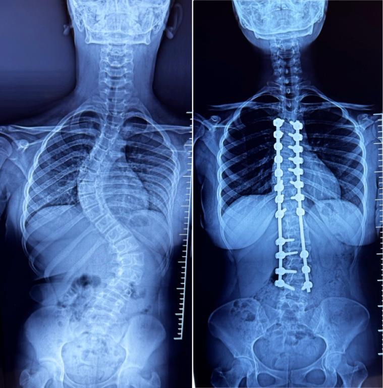 Scoliosis Correction Surgeries