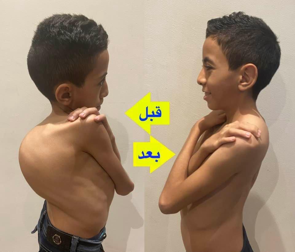 الاعوجاج المصاحب للتحدب بالعمود الفقري