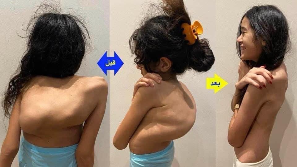 الاعوجاج المصاحب للتحدب بالعمود الفقري