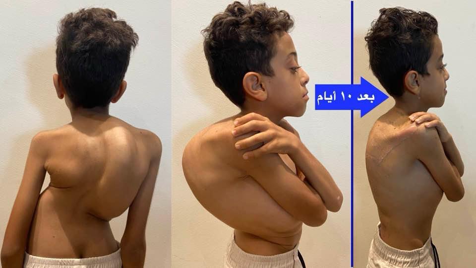 الاعوجاج المصاحب للتحدب بالعمود الفقري