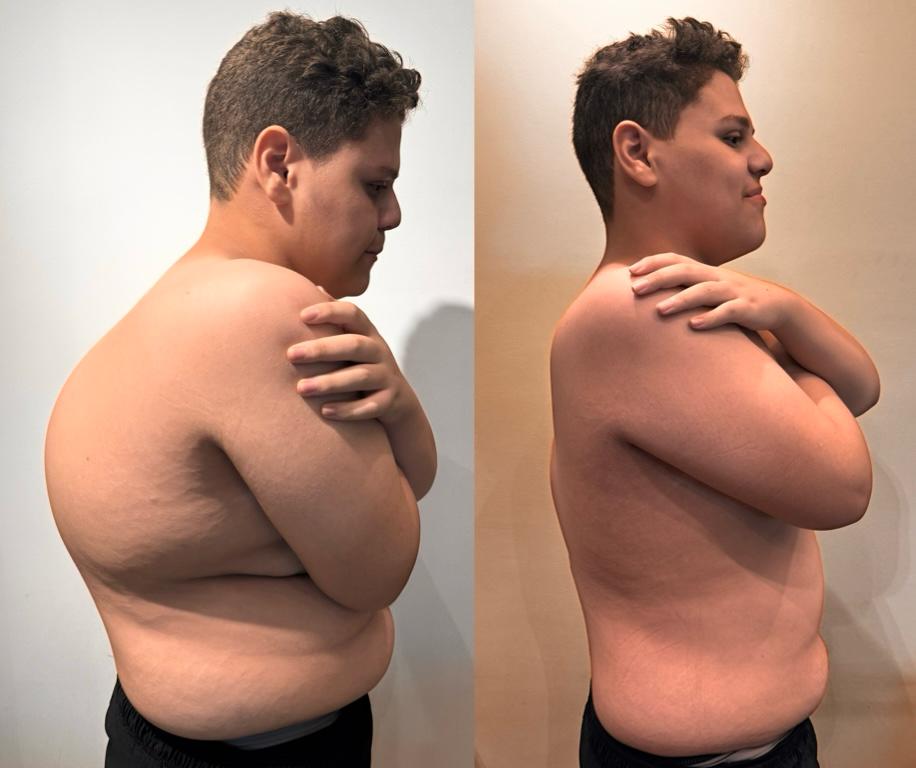Kyphosis Correction Surgeries