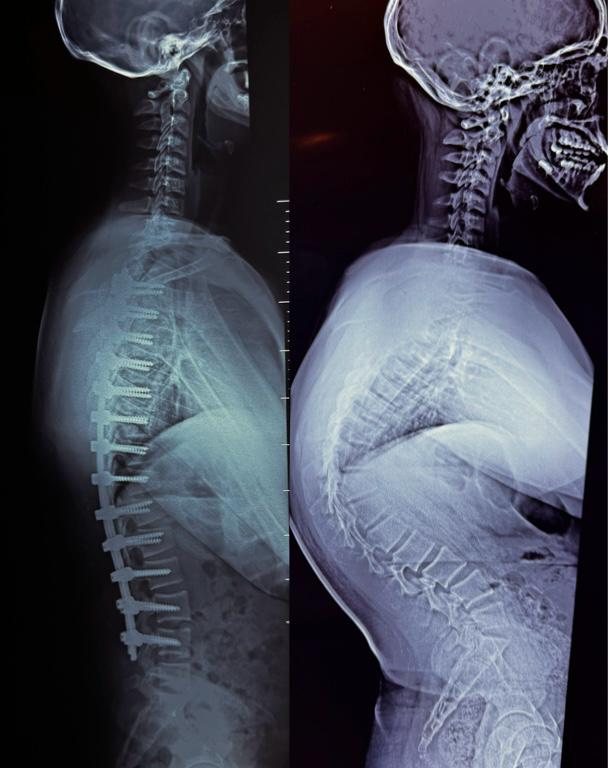 Kyphosis Correction Surgeries