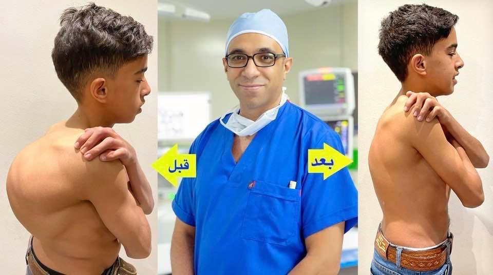 الاعوجاج المصاحب للتحدب بالعمود الفقري