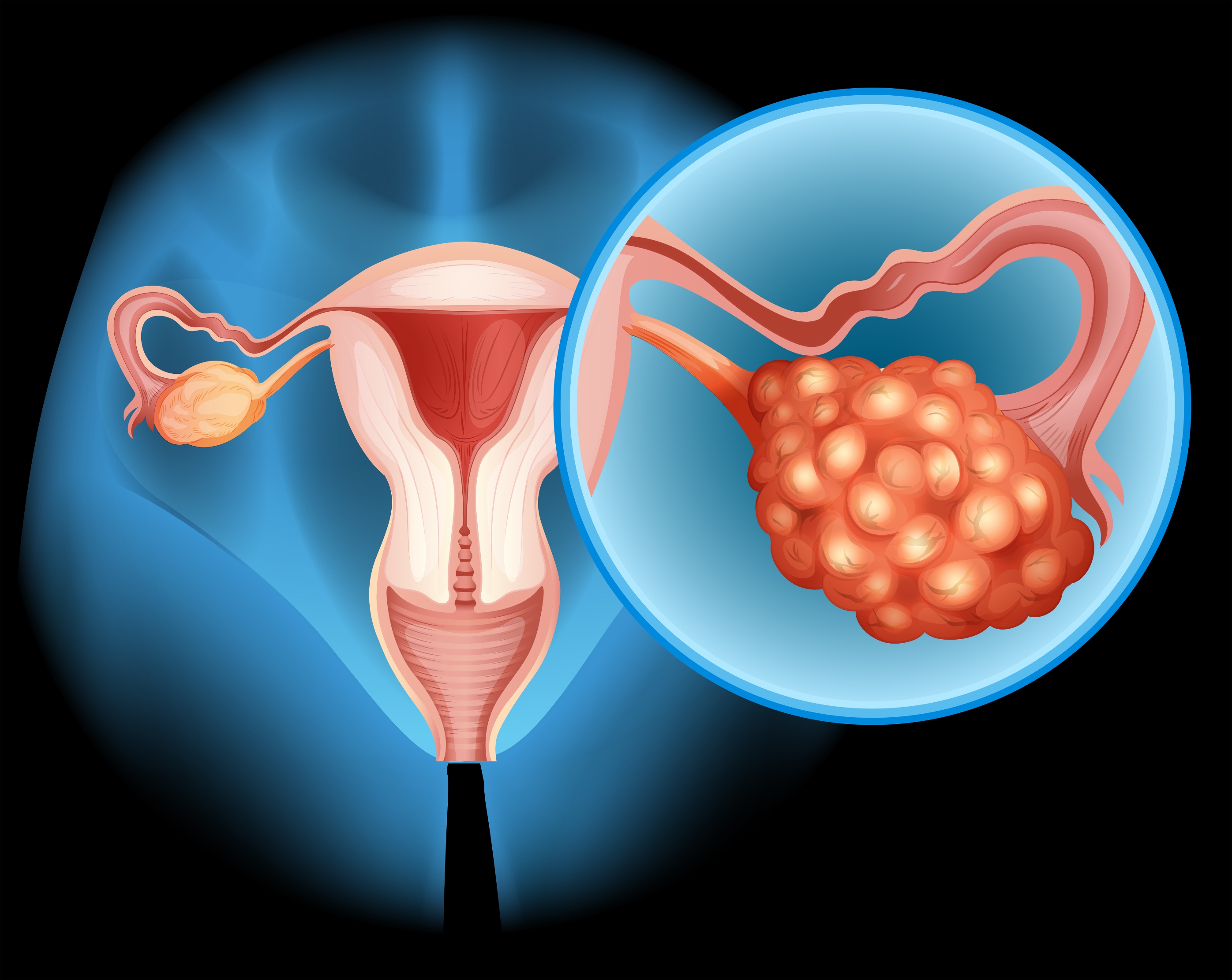 Uterine fibroids embolization