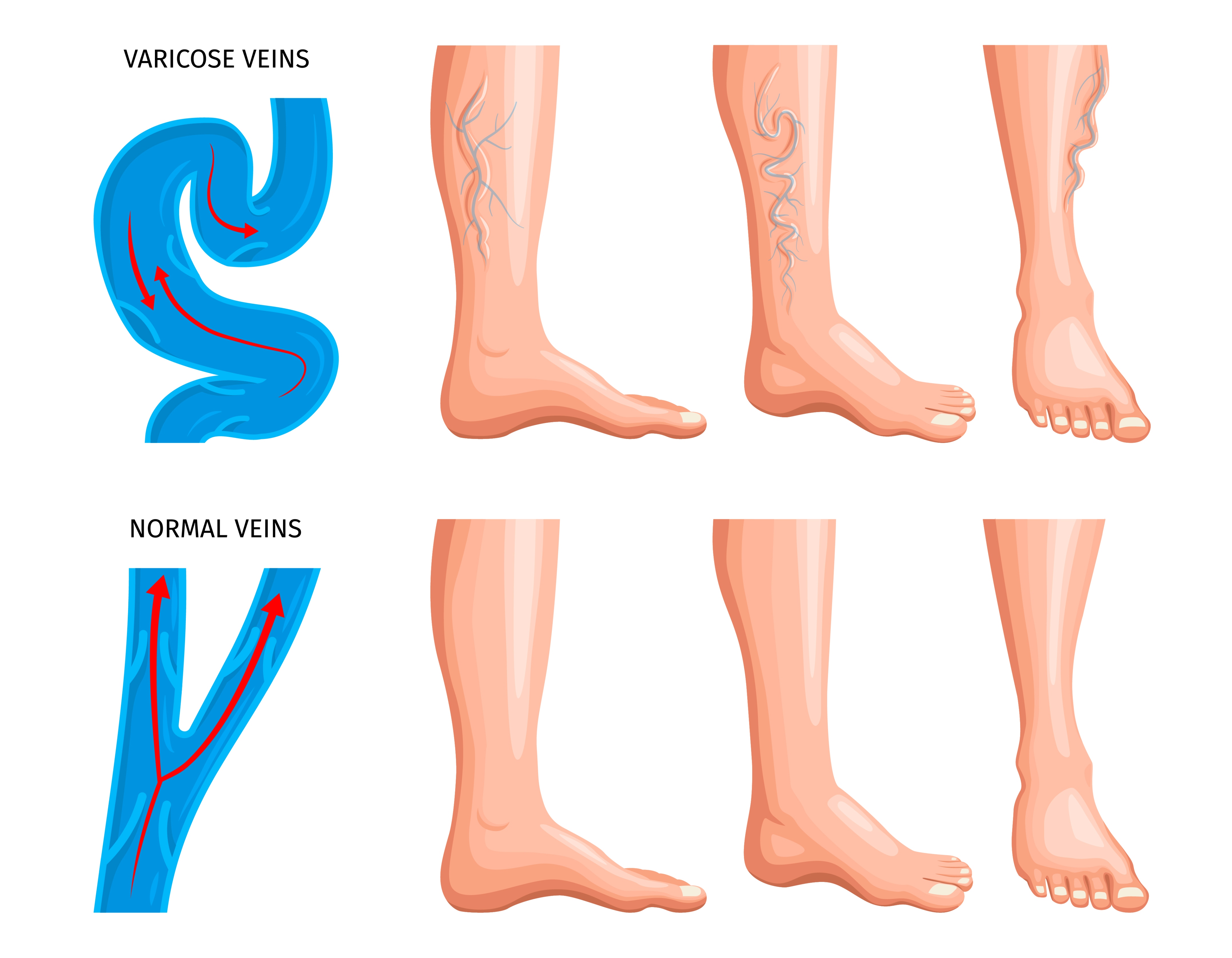 Varicose veins treatment without surgery