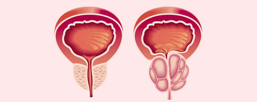 Prostatic artery embolization