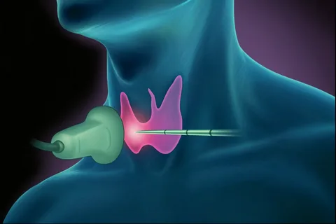 Thermal ablation of thyroid nodules